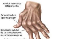 Artritis Reumatoide, 5 Recomendaciones Básicas artritis reumatoide