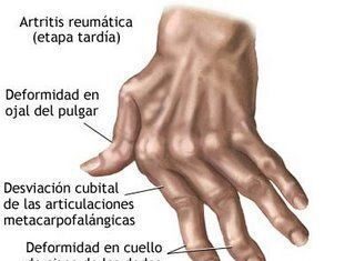 Artritis Reumatoide, 5 Recomendaciones Básicas artritis reumatoide