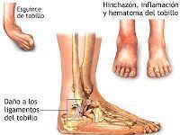 CLASIFICACIÓN y Tratamiento de los Esguinces de Tobillo