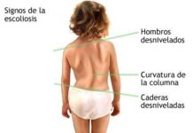 Escoliosis en la Infancia
