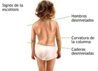 Escoliosis en la Infancia