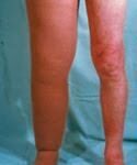 Linfedema