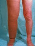 Linfedema