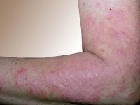 Contraindicaciones Crioterapia