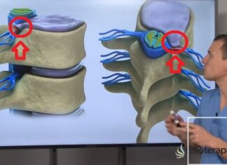 CONSEJOS para TRATAR una HERNIA DISCAL Hernia Discal comprimiendo nervio