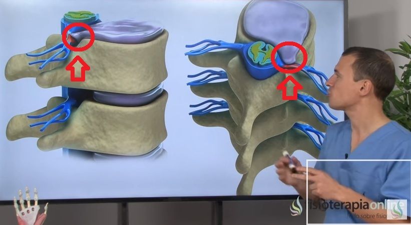 Hernia Discal comprimiendo nervio