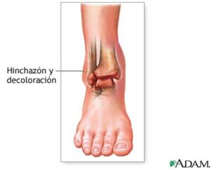 esguince de tobillo