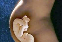 ¿Qué es la episiotomía?