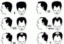 Implantes capilares. Ventajas y desventajas