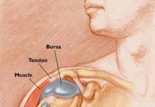 Bursitis