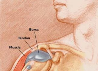 Bursitis