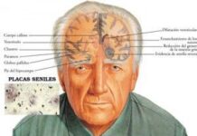 Demencia Senil: se triplicará para el 2050