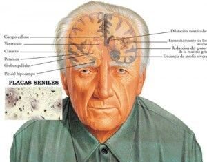 Demencia Senil: se triplicará para el 2050