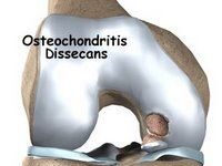 Análisis biomecánico comparativo de la articulación femoropatelar izquierda, en el golpe de derecha en un deportista con osteocondritis disecante, y no lesionado, de tenis
