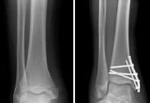 Cómo tratar una Fractura de Tobillo antes de que lleguen los médicos