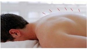 La acupuntura