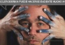 Enfermedades raras: Esclerodermia