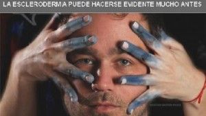 Enfermedades raras: Esclerodermia