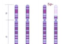 Enfermedades raras: Síndrome del maullido del gato