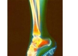 Los tacones favorecen la artritis
