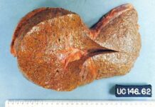 Agrimonia y Cardosanto Alivian Cirrosis Hepática