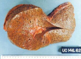 Agrimonia y Cardosanto Alivian Cirrosis Hepática
