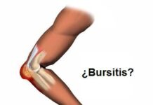 ¿Qué es la bursitis?