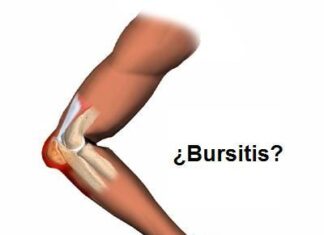 ¿Qué es la bursitis?