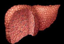 La Cirrosis Hepática y Su Tratamiento Natural