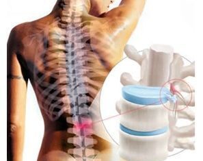 Cirugía para hernias lumbares