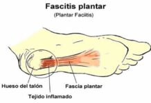 Fascitis plantar, problema y solución
