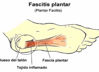 Fascitis plantar, problema y solución