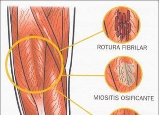 Micro-rotura fibrilar
