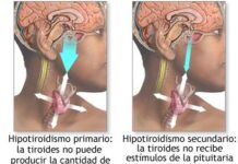 Cómo detectar el hipotiroidismo