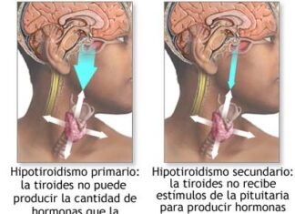Cómo detectar el hipotiroidismo