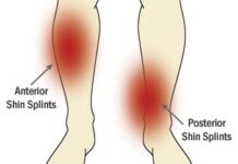 La Periostitis. Qué es y cómo tratarla