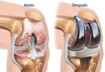 REEMPLAZO total de RODILLA – ARTROPLASTIA total de Rodilla – Prótesis de Rodilla