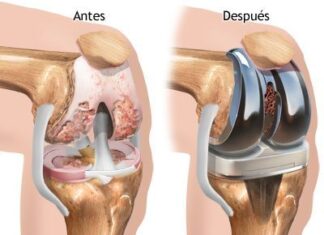 REEMPLAZO total de RODILLA – ARTROPLASTIA total de Rodilla – Prótesis de Rodilla