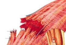 Lesiones musculares por traumatismo directo e indirecto