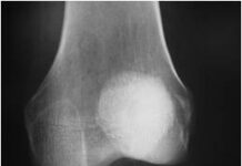 Lesiones De La Rodilla