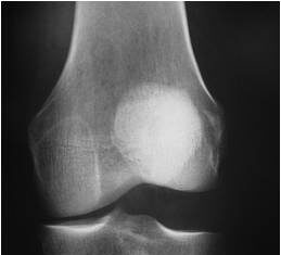Lesiones De La Rodilla