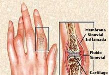 Osteoartritis de las manos osteoartritis