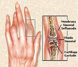 Osteoartritis de las manos osteoartritis