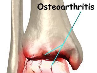 Etapas de la Osteoartritis