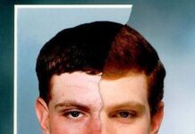 ¿Por qué sale el acné?