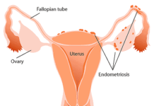 La Endometriosis: Qué es, Síntomas y Tratamiento