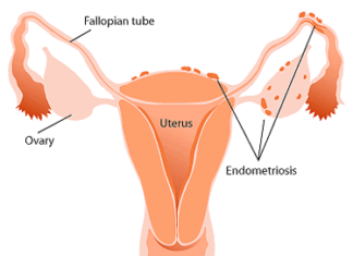 La Endometriosis: Qué es, Síntomas y Tratamiento
