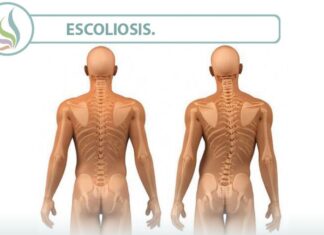 ESCOLIOSIS ¡Guía completa! Clasificación, Síntomas, Tratamiento… La ESCOLIOSIS