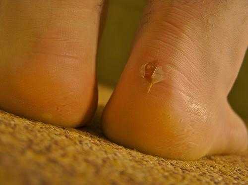 ampollas en los pies 