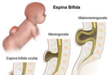 ¿Qué es la espina bífida?